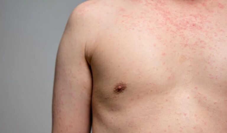 Qual a diferença entre manchas de dengue e de outras doenças?