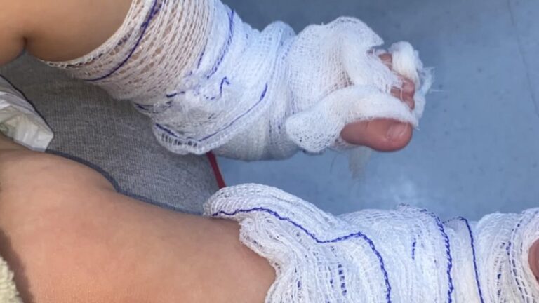 Bebê de 11 meses sofre queimaduras de segundo grau após banho em escola gaúcha